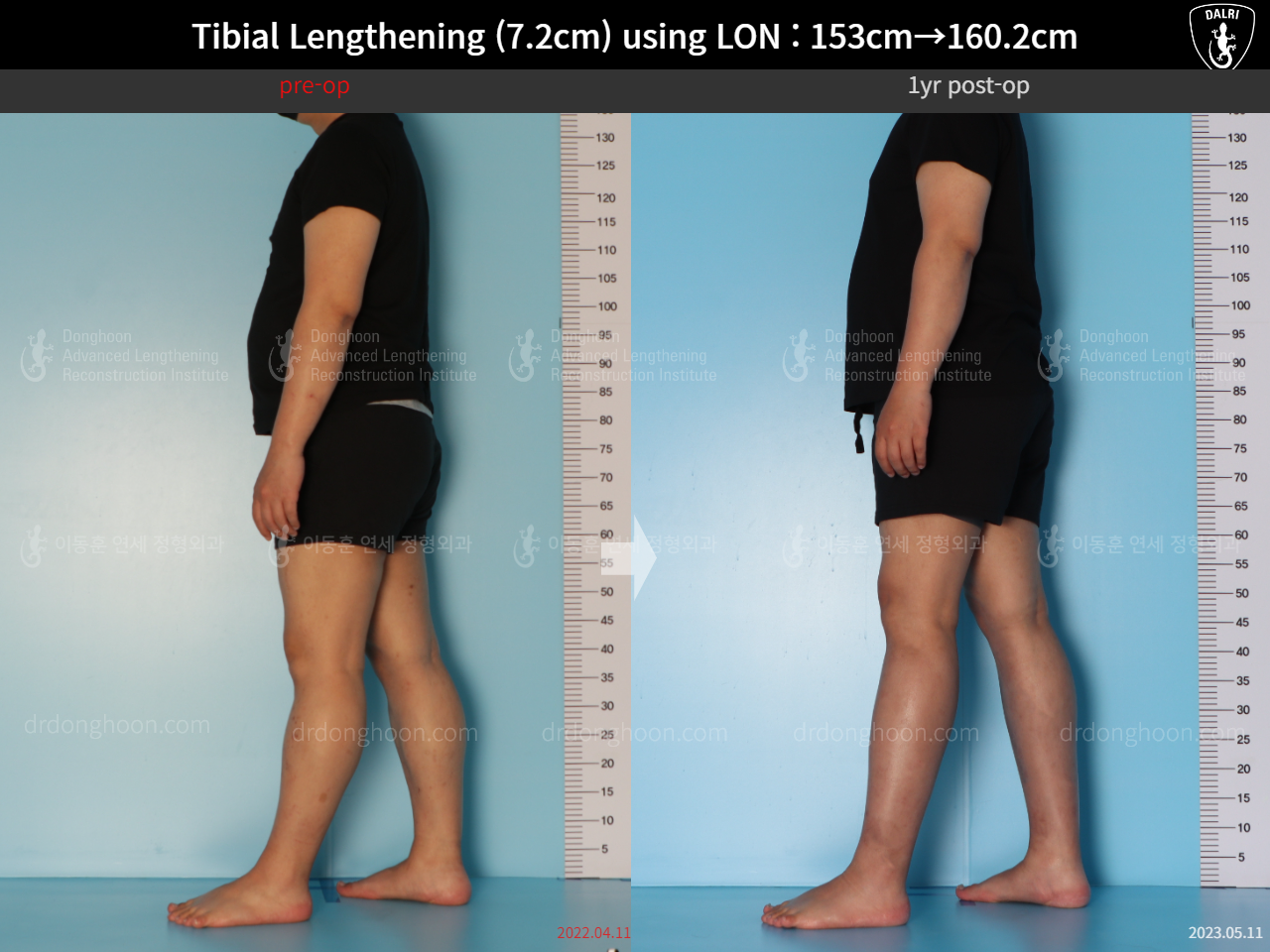 Before and after cll lon, case 15150707, image 4, Dr. Donghoon institute (DALRI)
