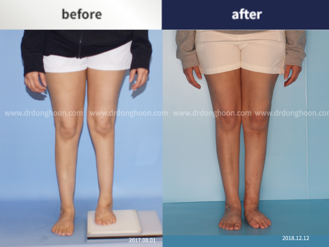 Before and after complex deformity, case 4795338, image 1, Dr. Donghoon institute (DALRI)