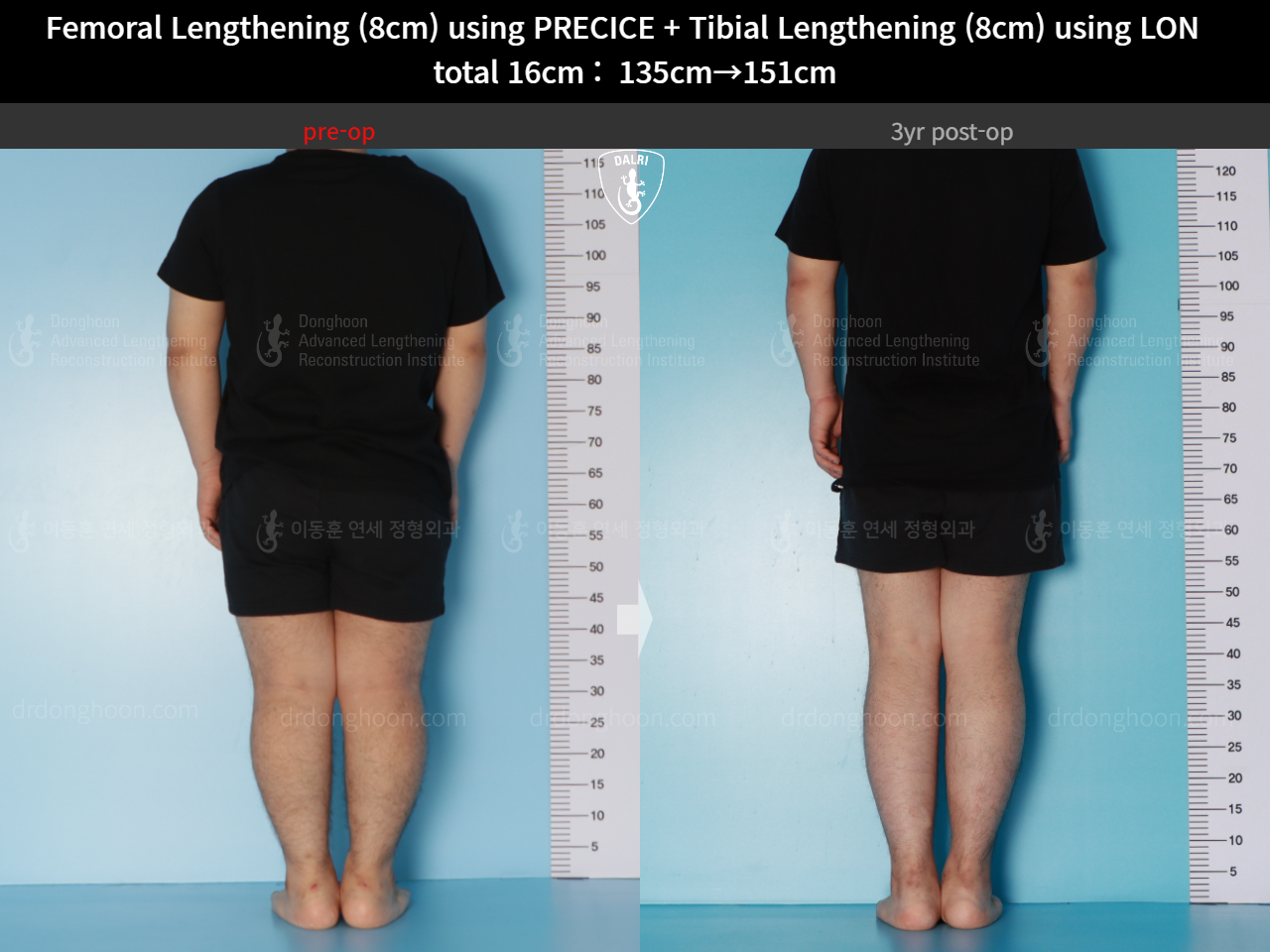 Before and after cll lon, case 16524730, image 6, Dr. Donghoon institute (DALRI)