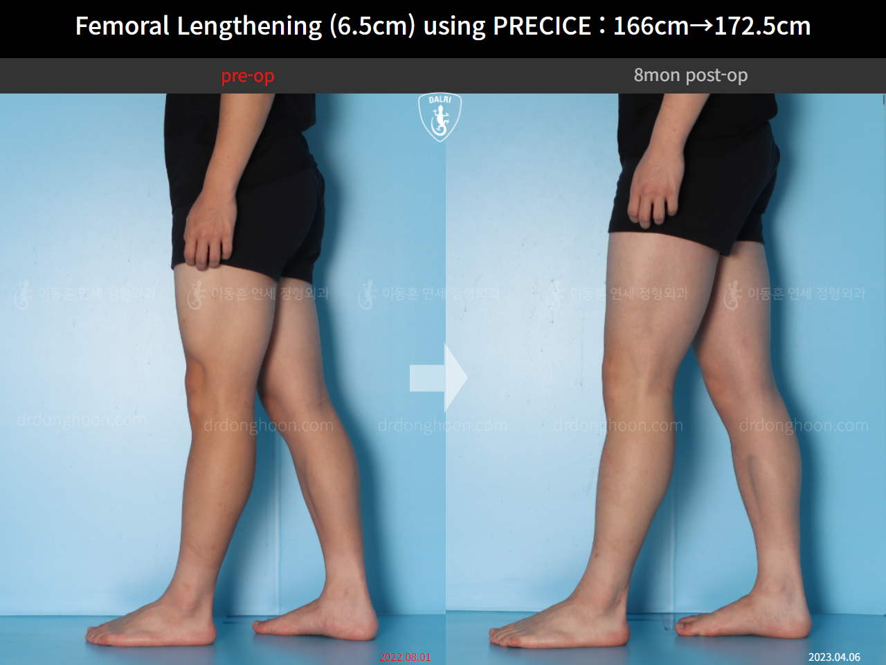 Before and after cll precice, case 14706614, image 11, Dr. Donghoon institute (DALRI)
