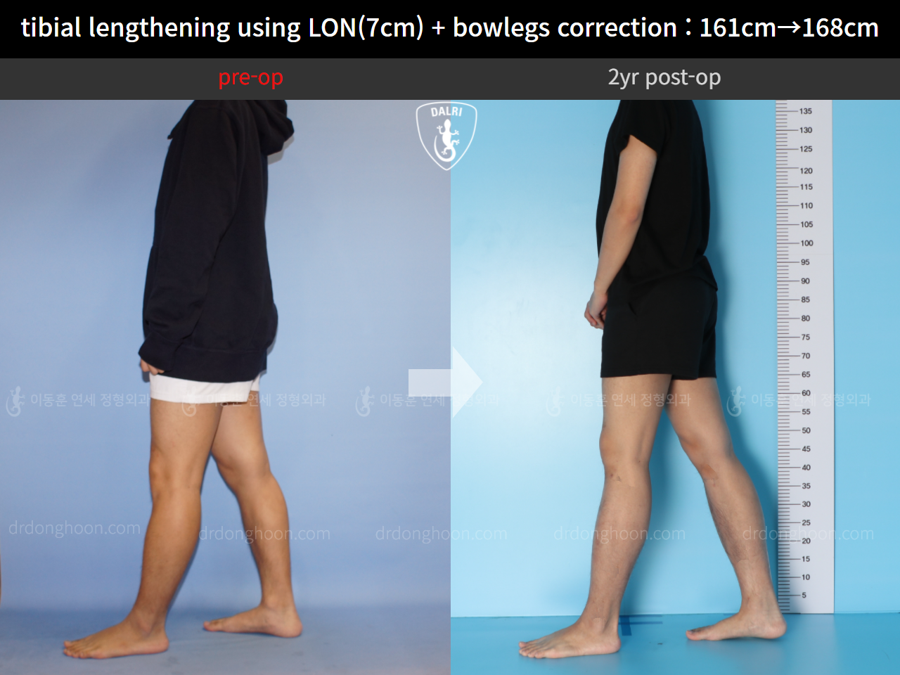 Before and after cll + deformity correction, case 10400088, image 3, Dr. Donghoon institute (DALRI)