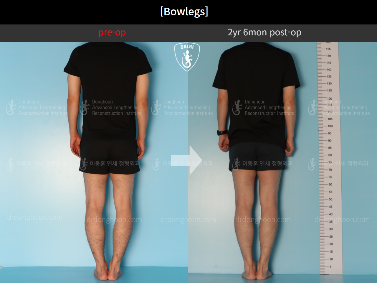 Before and after adult bowlegs, case 11037119, image 4, Dr. Donghoon institute (DALRI)
