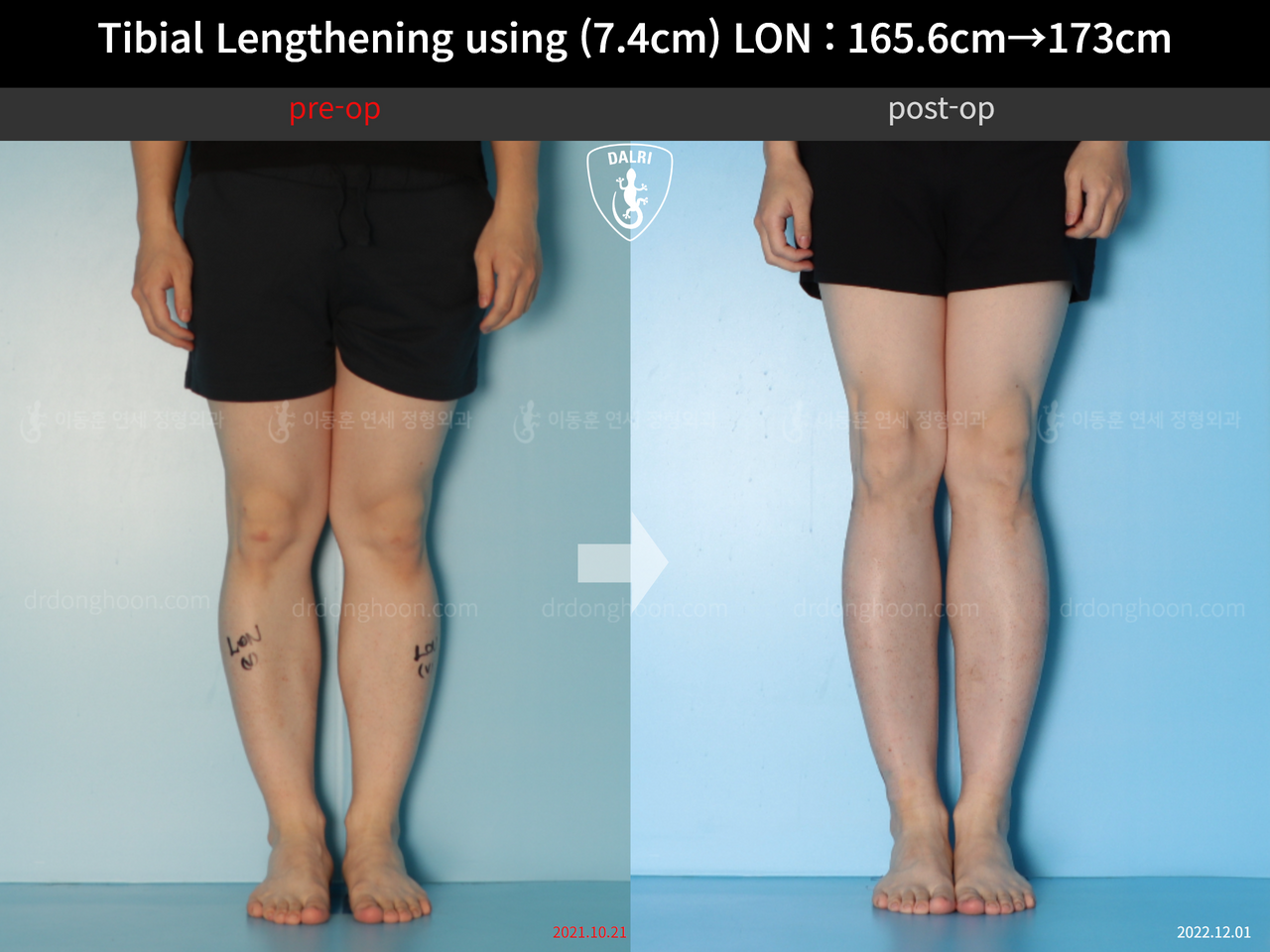 Before and after cll lon, case 13634644, image 5, Dr. Donghoon institute (DALRI)