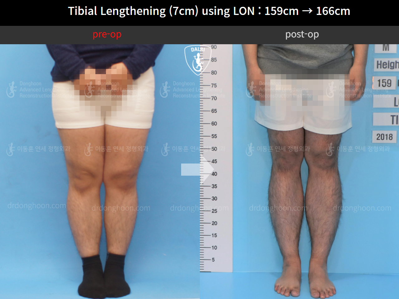 Before and after cll lon, case 9869704, image 3, Dr. Donghoon institute (DALRI)