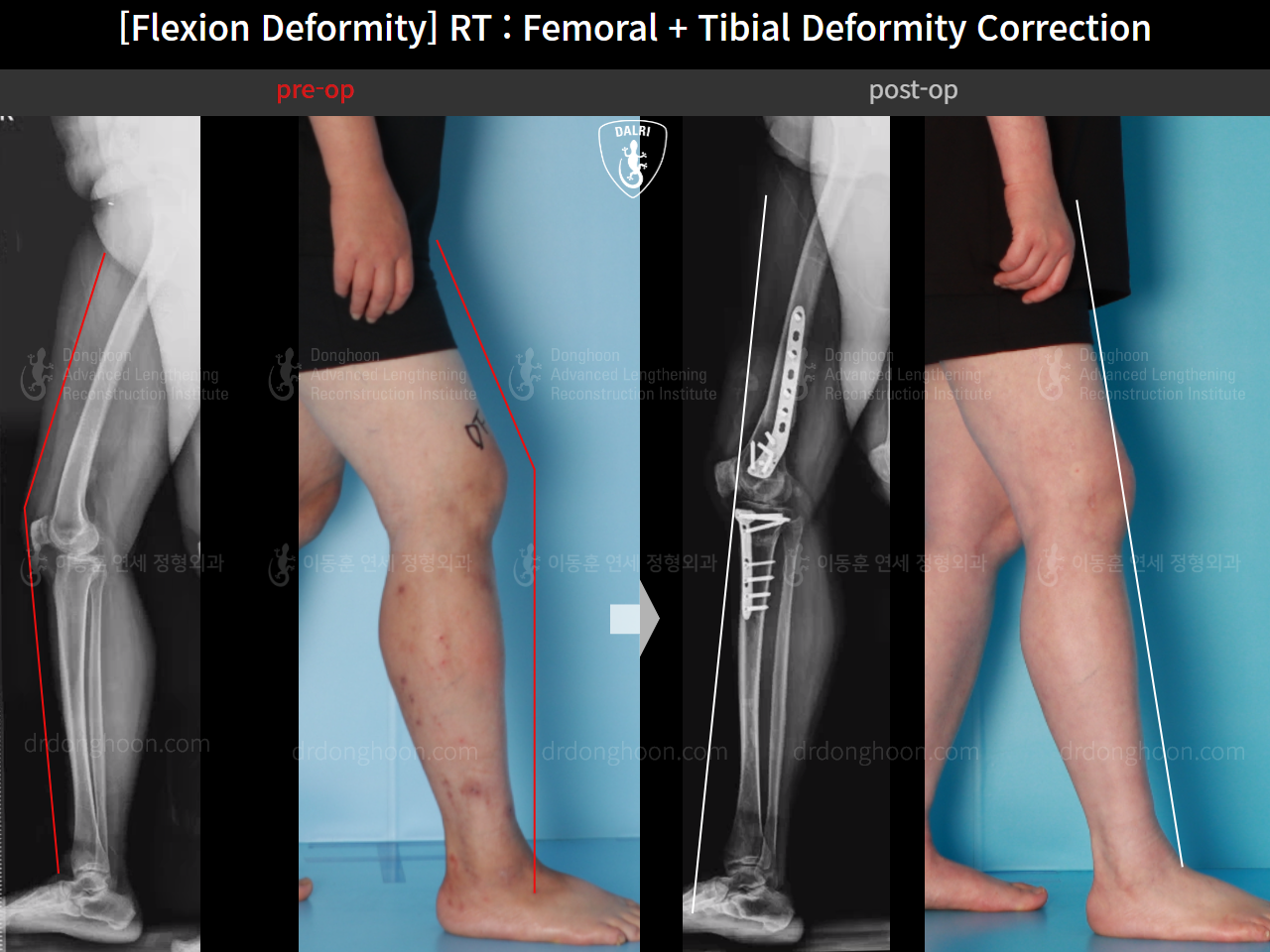 Before and after flexion deformity, case 15993081, image 1, Dr. Donghoon institute (DALRI)