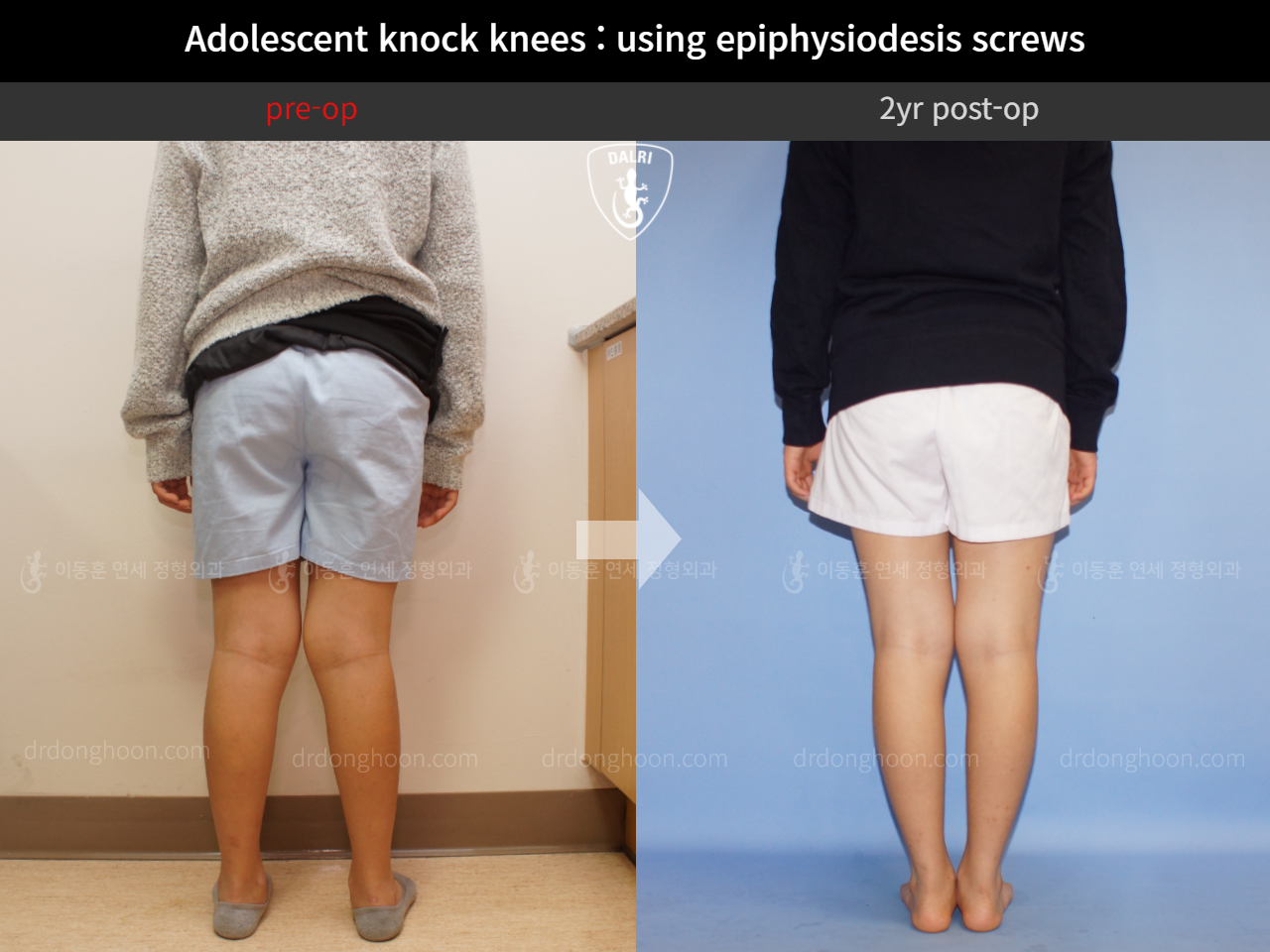 Before and after paediatric & adolescent knock knees, case 4640518, image 4, Dr. Donghoon institute (DALRI)
