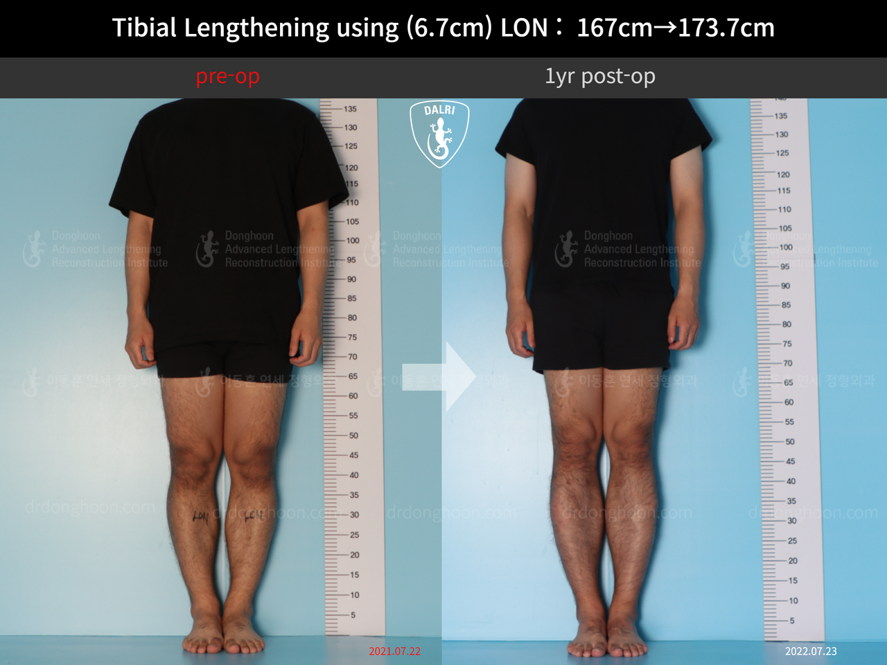 Before and after cll lon, case 12426969, image 1, Dr. Donghoon institute (DALRI)