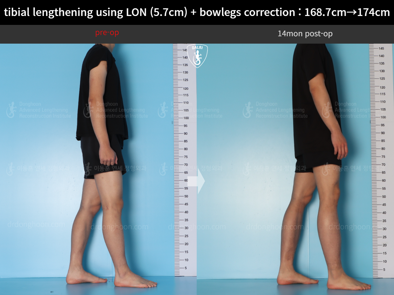 Before and after cll + deformity correction, case 18160780, image 4, Dr. Donghoon institute (DALRI)