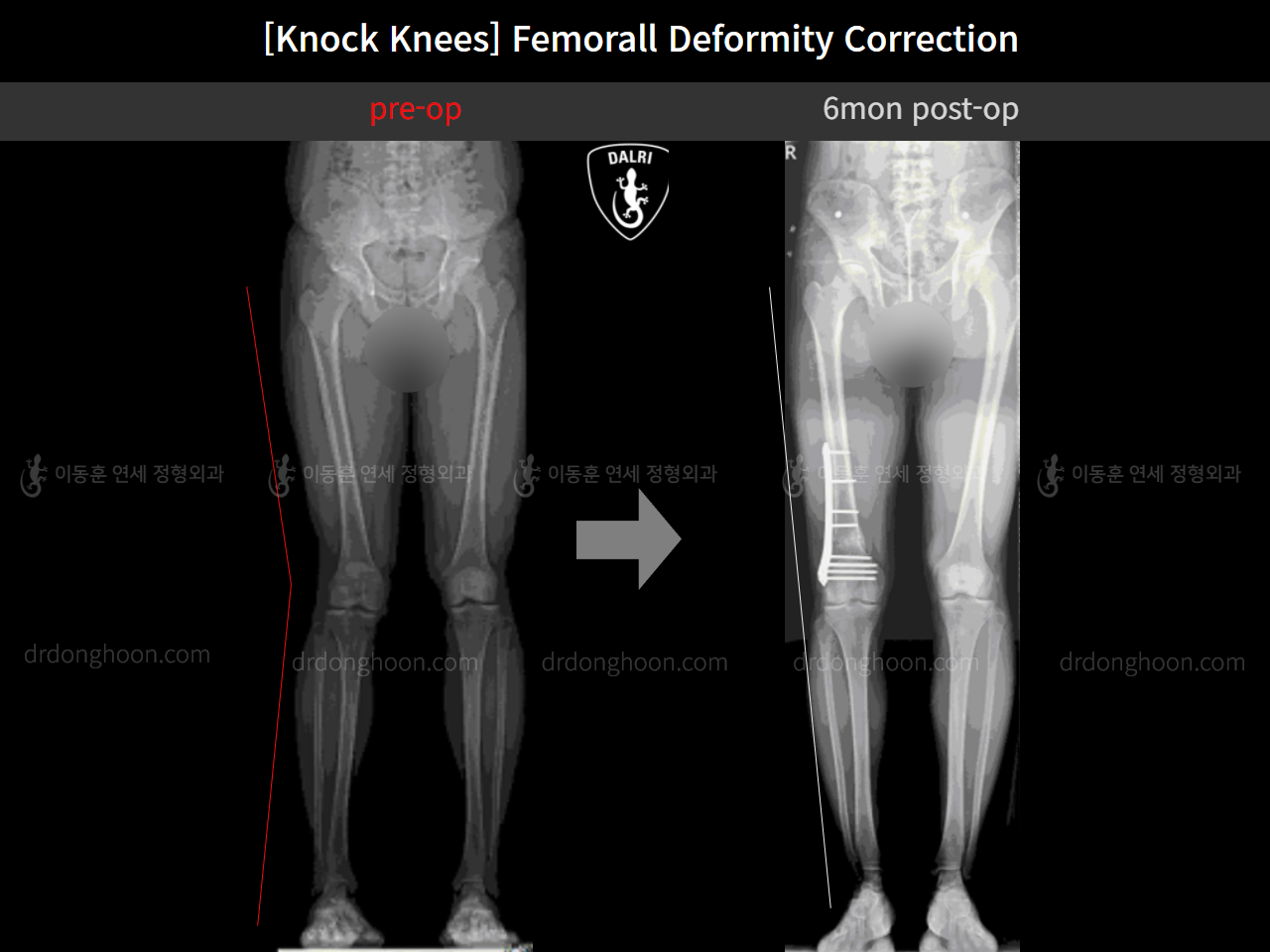 Before and after adult knock knees, case 11773301, image 6, Dr. Donghoon institute (DALRI)