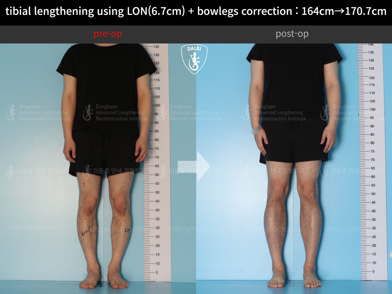 Before and after cll + deformity correction, case 13914972, image 2, Dr. Donghoon institute (DALRI)