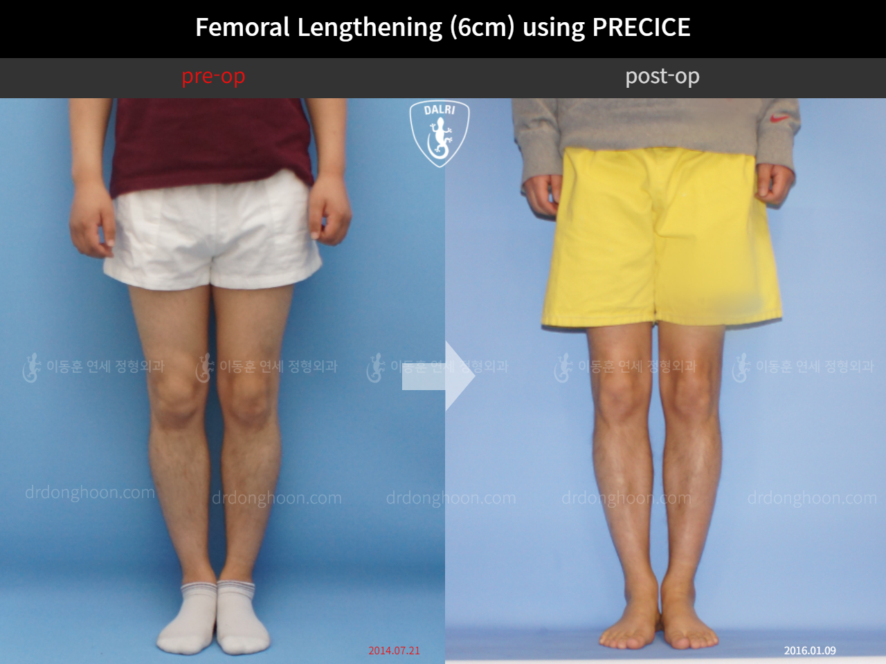 Before and after cll precice, case 4573616, image 3, Dr. Donghoon institute (DALRI)
