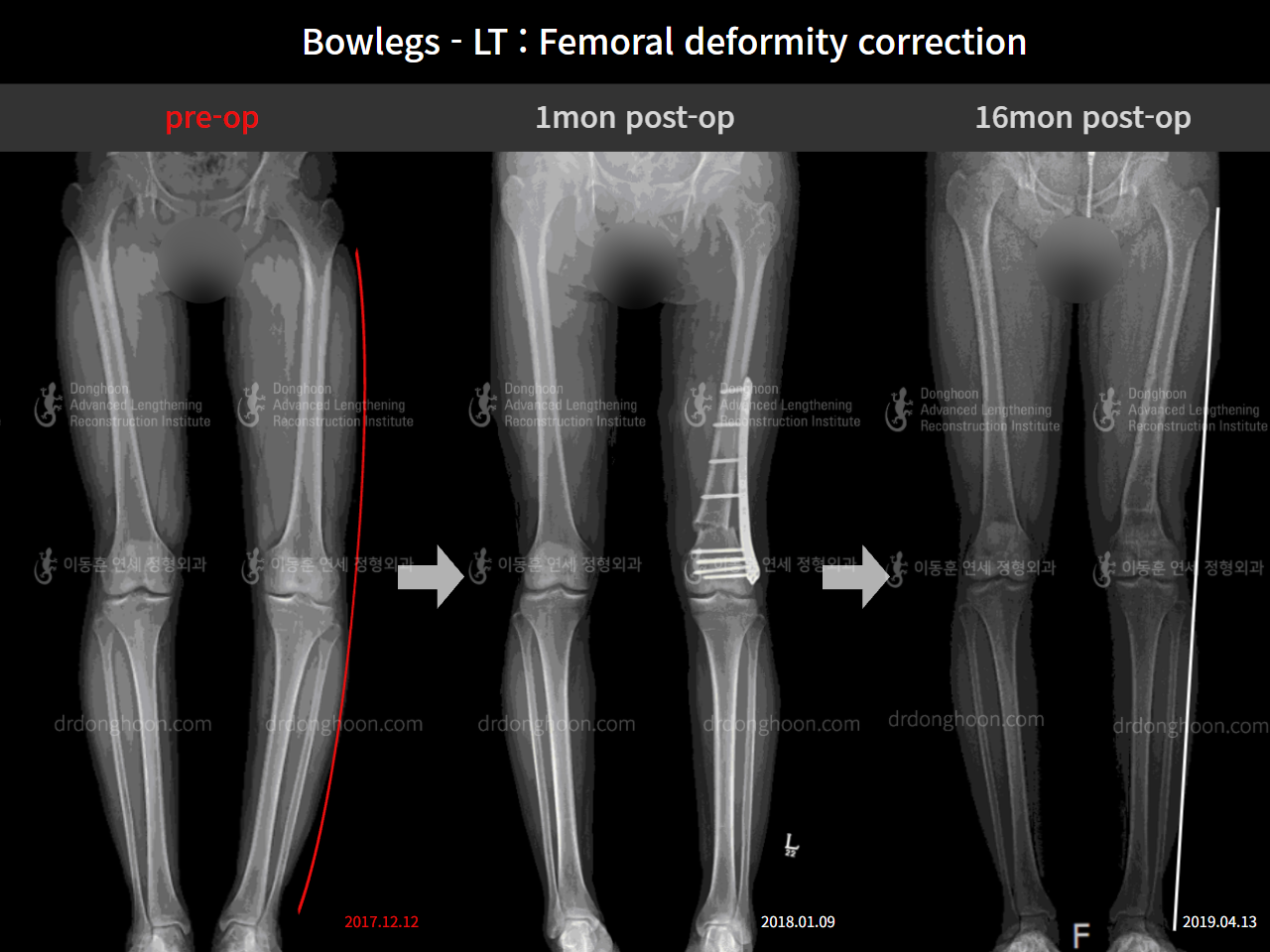 Before and after adult bowlegs, case 8932864, image 5, Dr. Donghoon institute (DALRI)
