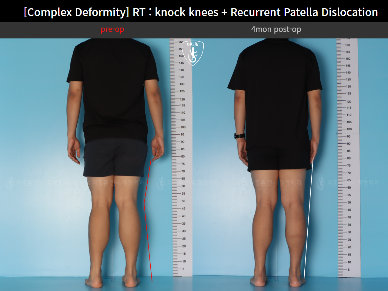 Before and after recurrent patella dislocation, case 125841847, image 4, Dr. Donghoon institute (DALRI)