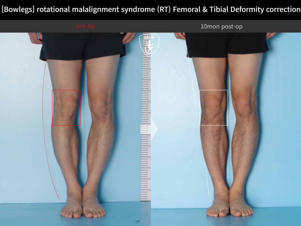 Before and after adult bowlegs, case 14220550, image 4, Dr. Donghoon institute (DALRI)