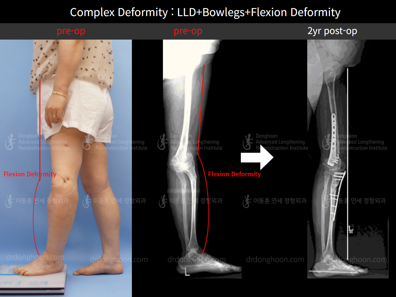 Before and after adult lld, case 8892419, image 2, Dr. Donghoon institute (DALRI)