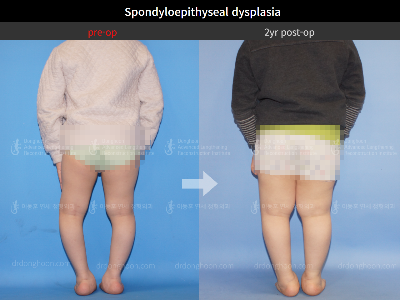 Before and after paediatric congenital condition, case 4304778, image 2, Dr. Donghoon institute (DALRI)