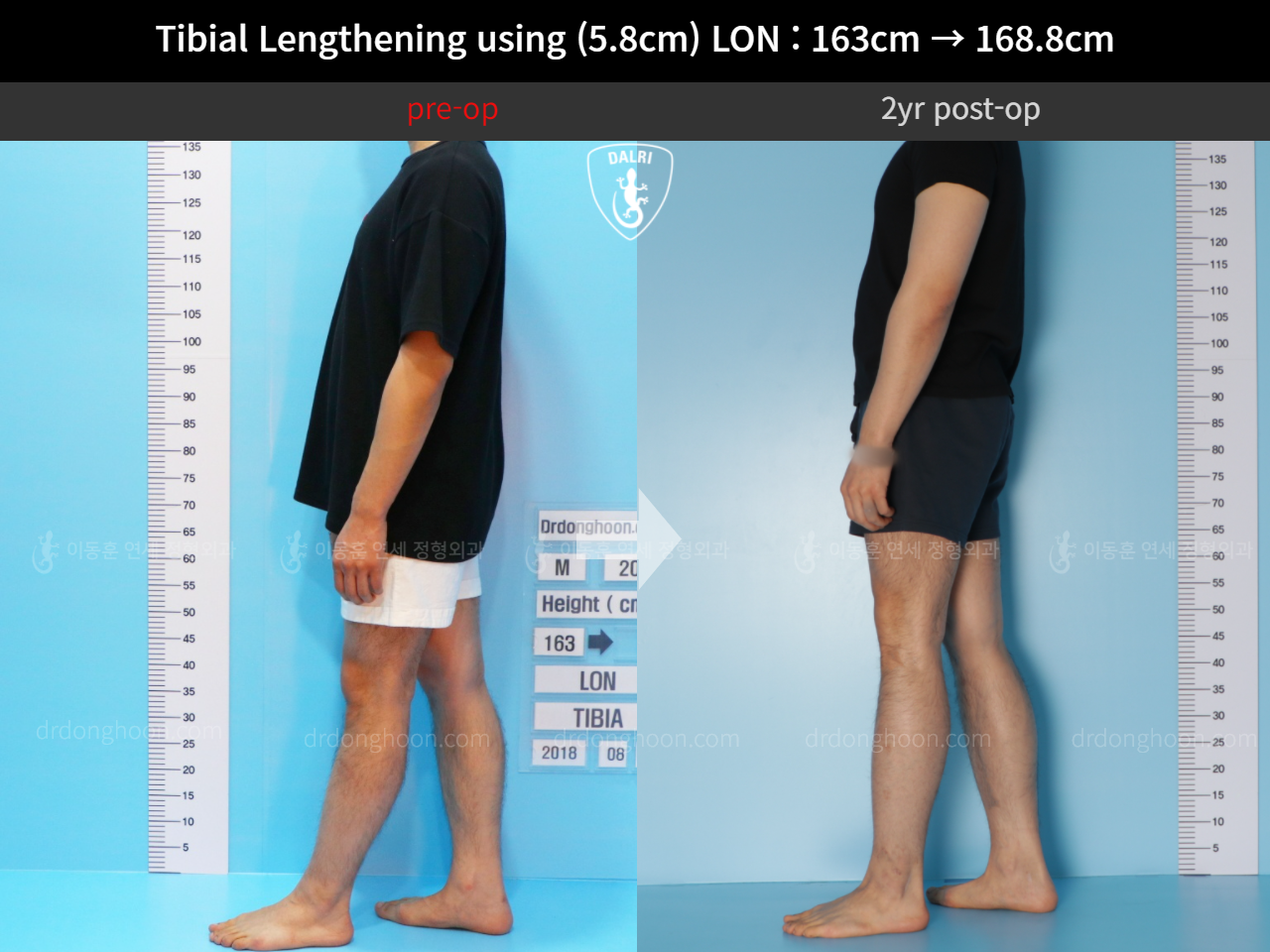 Before and after cll lon, case 11468172, image 4, Dr. Donghoon institute (DALRI)