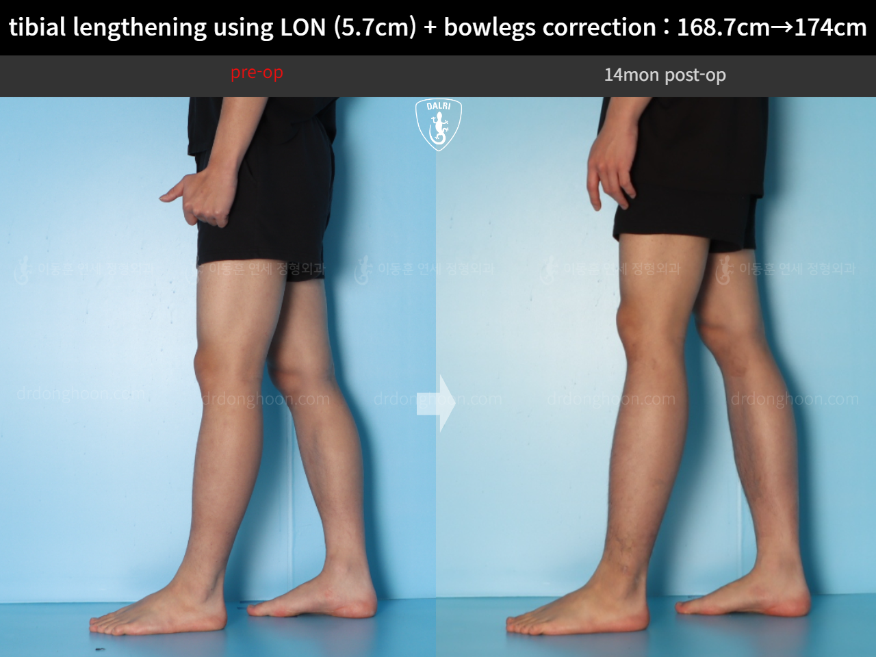 Before and after cll + deformity correction, case 18160780, image 10, Dr. Donghoon institute (DALRI)