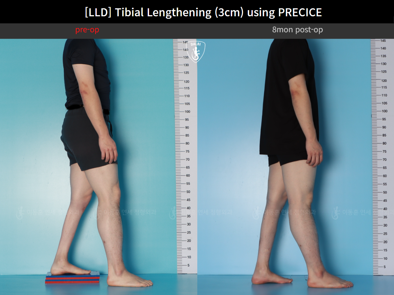 Before and after adult lld, case 124813877, image 4, Dr. Donghoon institute (DALRI)