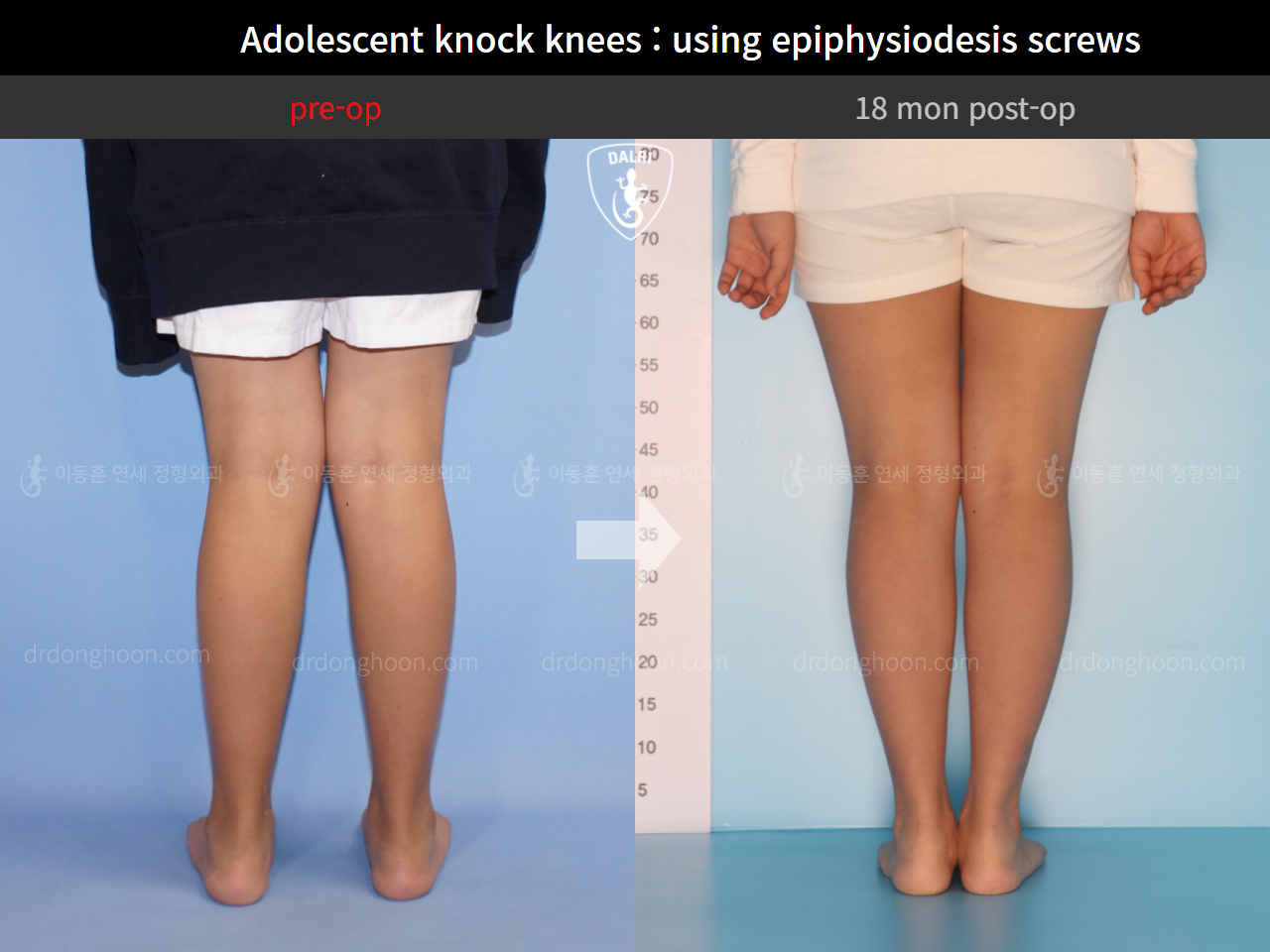 Before and after paediatric & adolescent knock knees, case 4310950, image 4, Dr. Donghoon institute (DALRI)