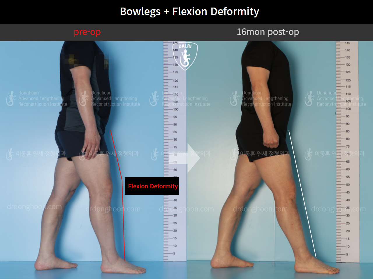 Before and after complex deformity, case 10451189, image 3, Dr. Donghoon institute (DALRI)
