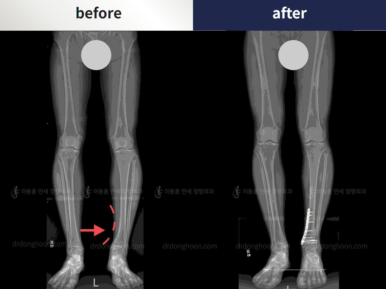 Before and after foot & ankle deformity, case 4246372, image 2, Dr. Donghoon institute (DALRI)