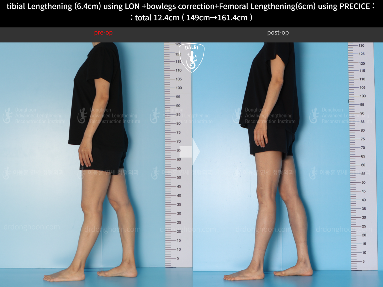 Before and after cll lon, case 13696249, image 8, Dr. Donghoon institute (DALRI)