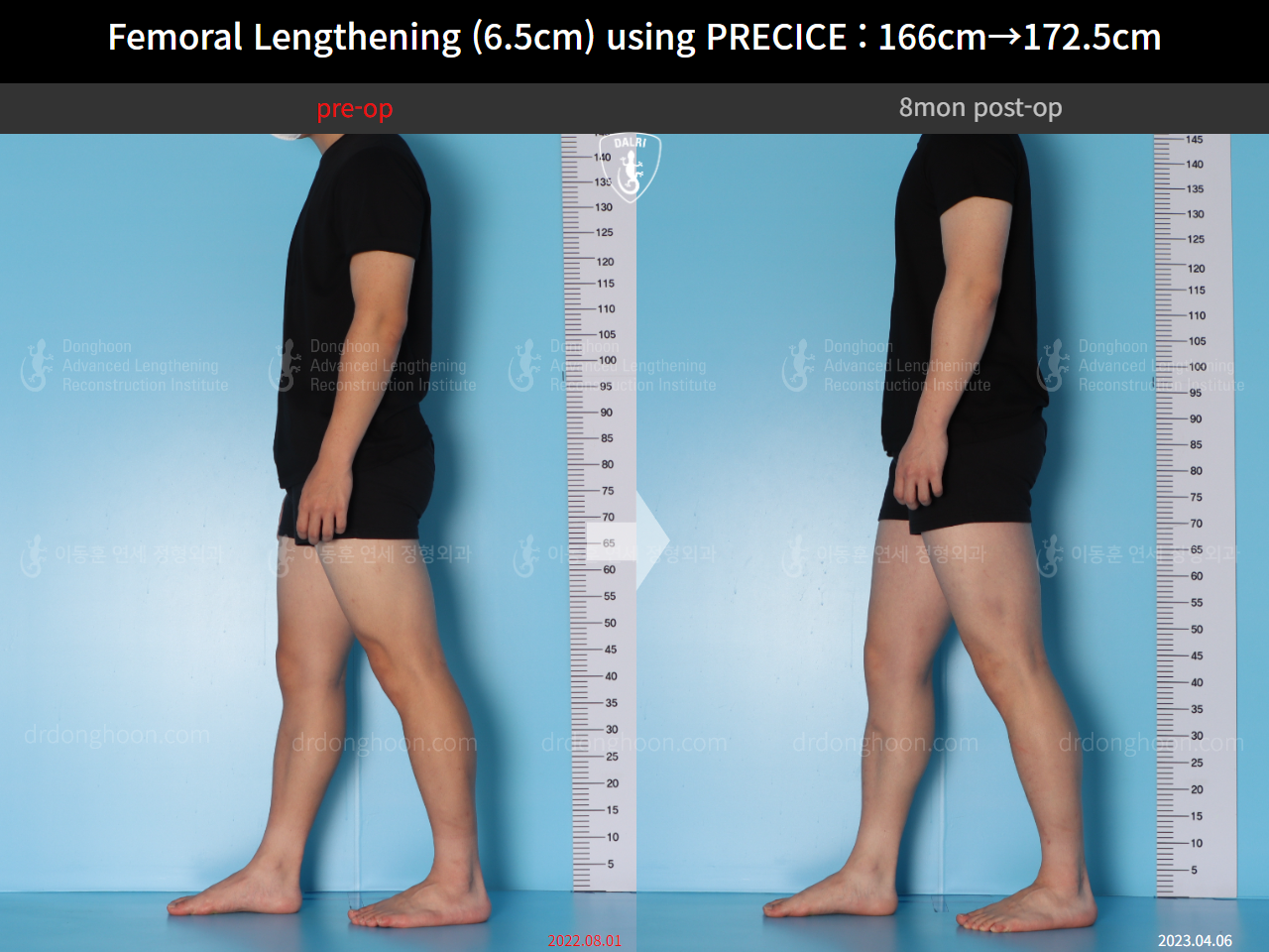 Before and after cll precice, case 14706614, image 6, Dr. Donghoon institute (DALRI)