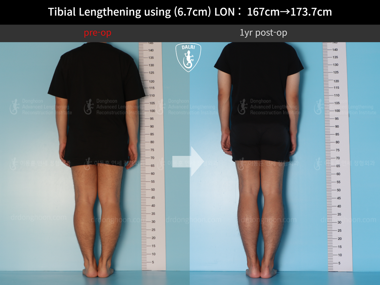 Before and after cll lon, case 12426969, image 2, Dr. Donghoon institute (DALRI)