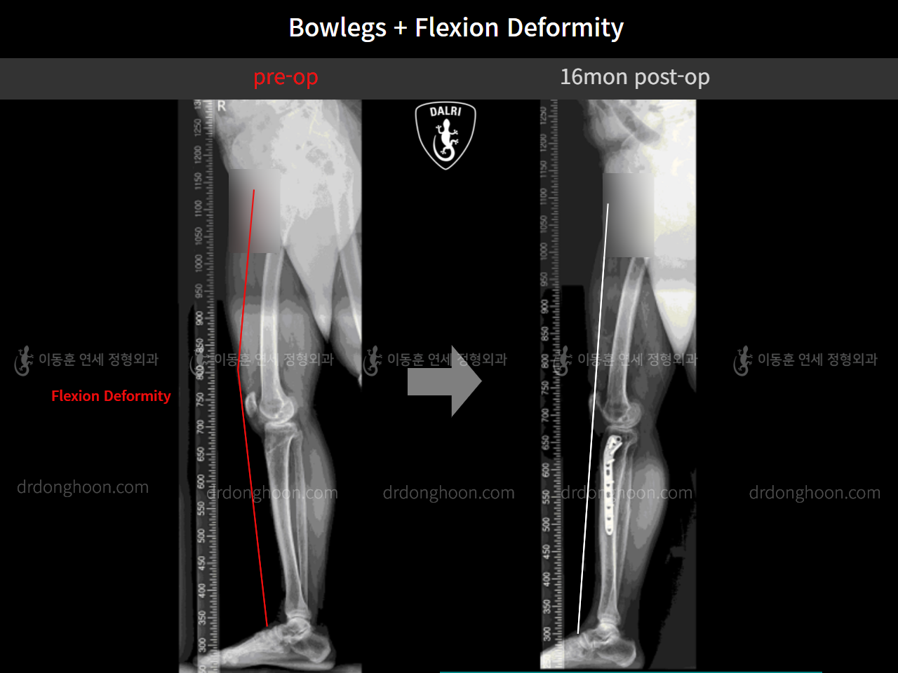Before and after adult bowlegs, case 10451182, image 8, Dr. Donghoon institute (DALRI)