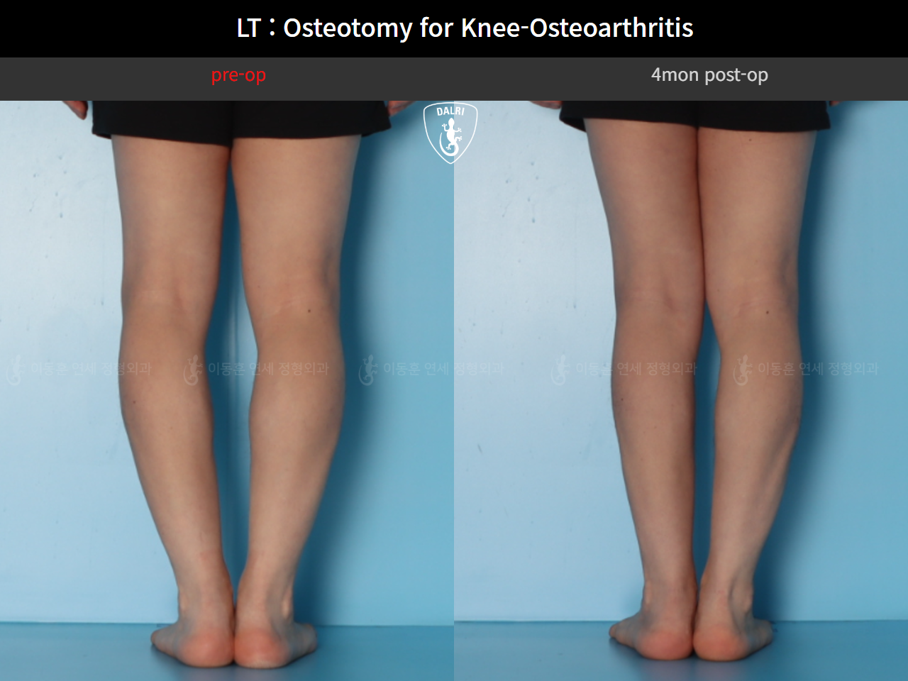 Before and after osteotomy for knee osteoarthritis, case 128374850, image 9, Dr. Donghoon institute (DALRI)