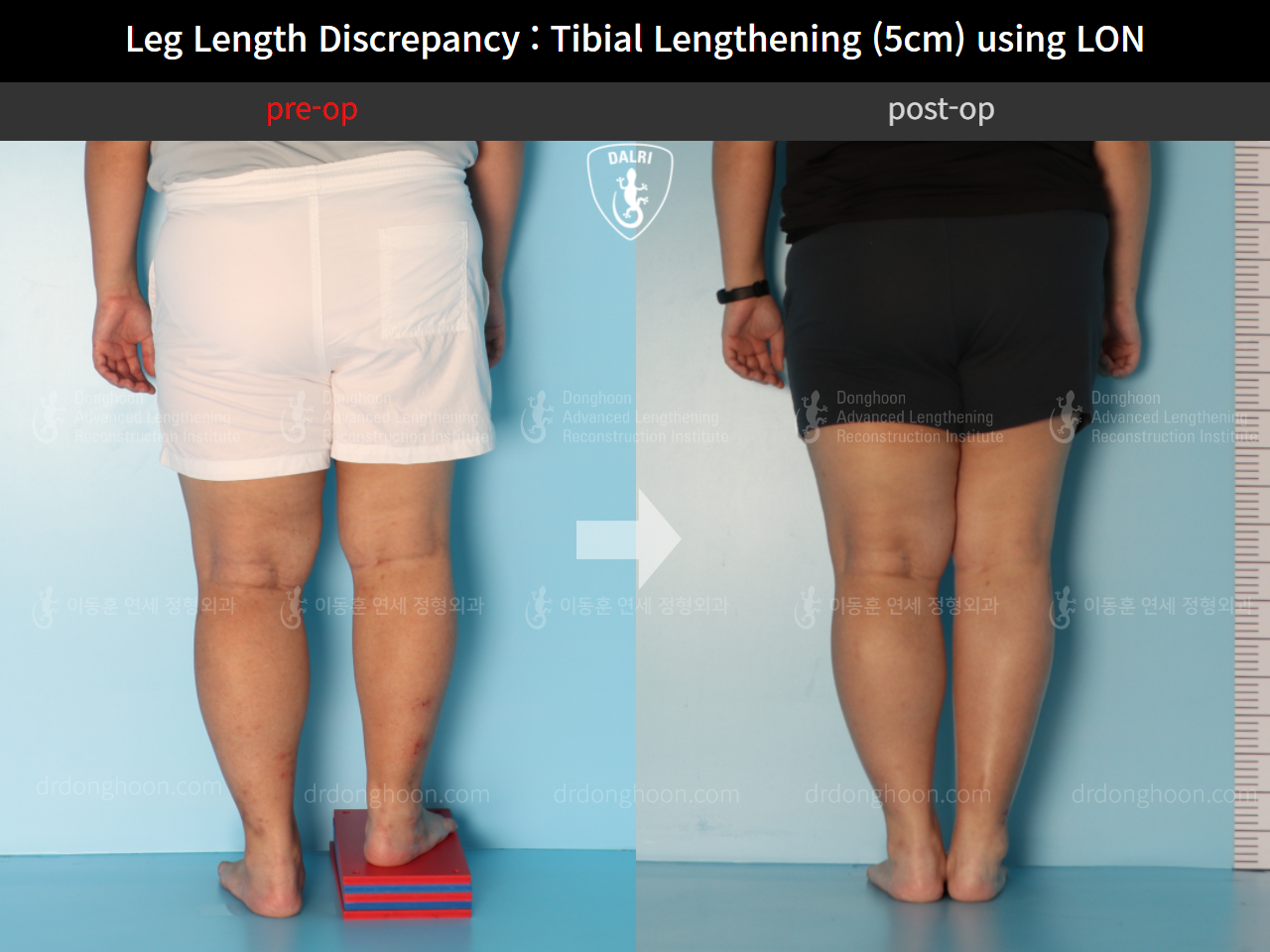 Before and after adult lld, case 9974673, image 5, Dr. Donghoon institute (DALRI)