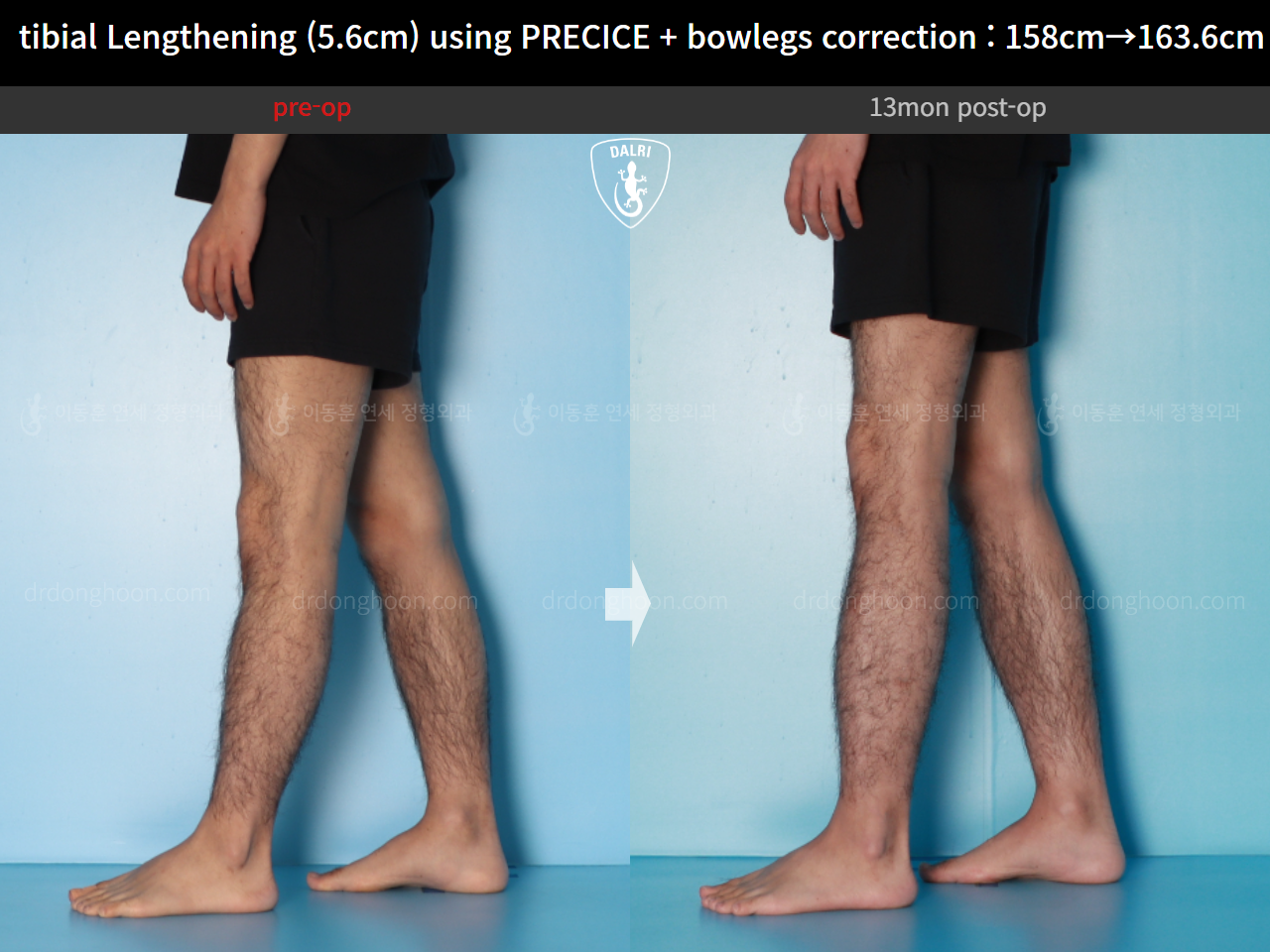 Before and after cll precice, case 16213622, image 9, Dr. Donghoon institute (DALRI)