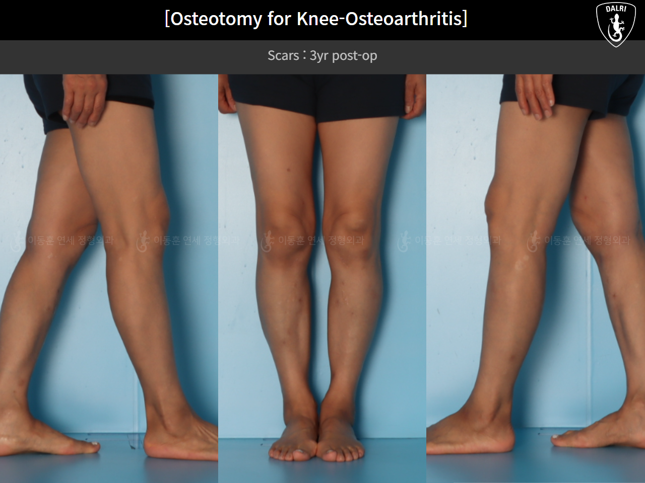 Before and after osteotomy for knee osteoarthritis, case 85842641, image 10, Dr. Donghoon institute (DALRI)