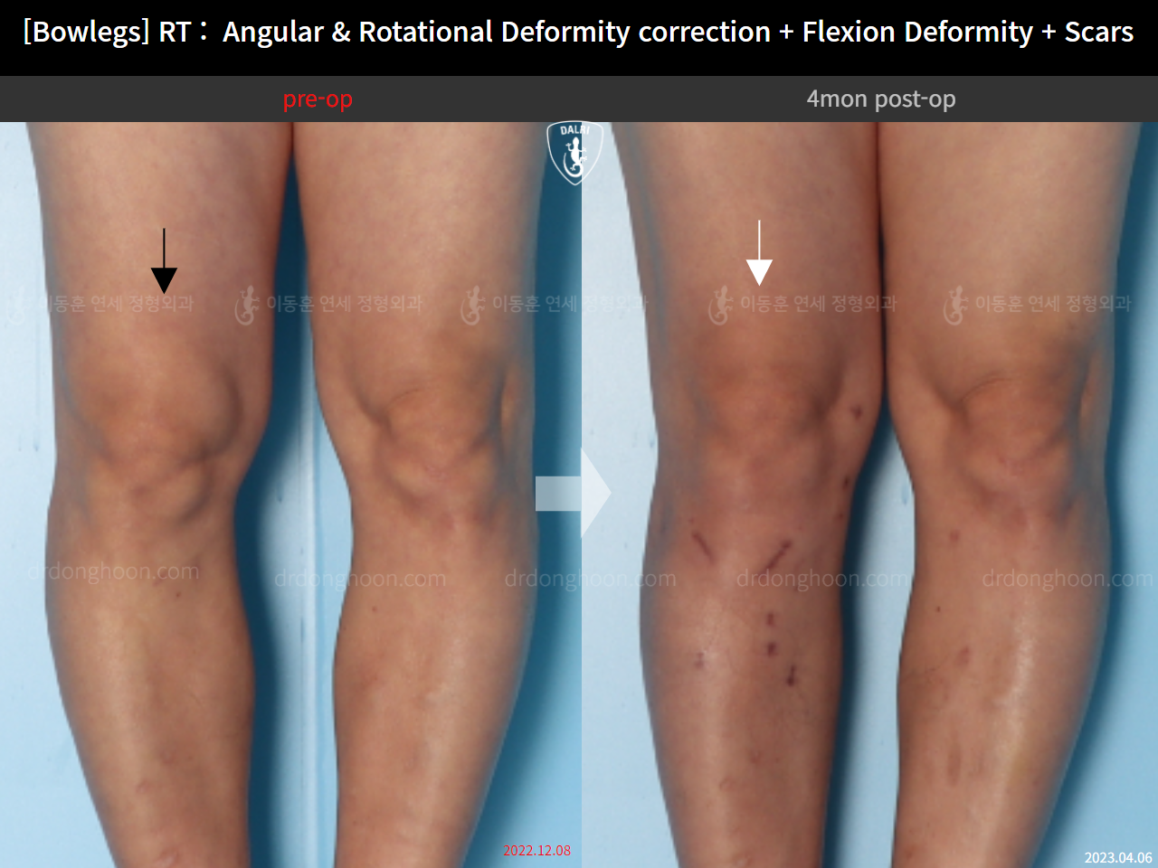 Before and after adult bowlegs, case 14701830, image 6, Dr. Donghoon institute (DALRI)