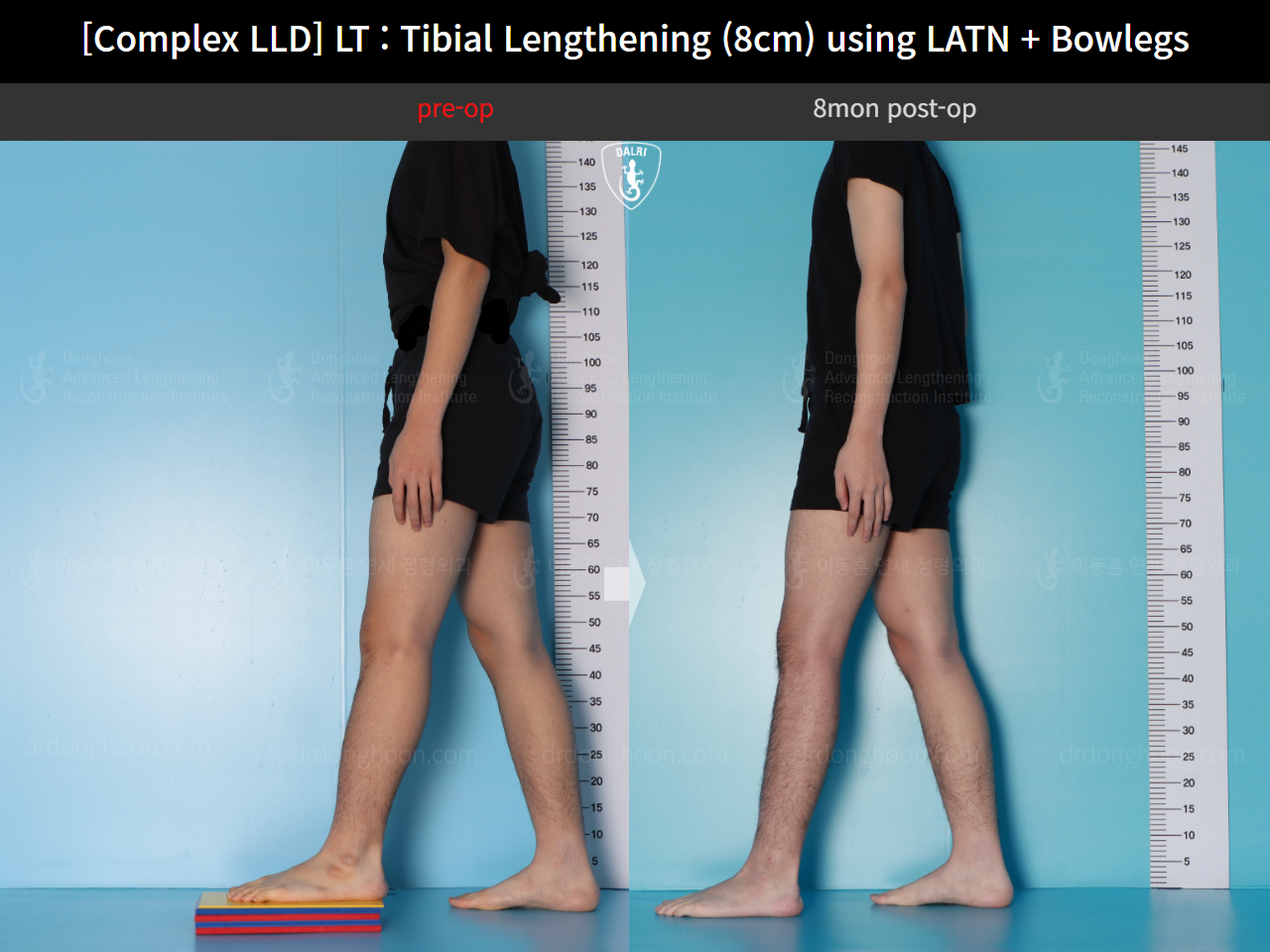 Before and after adult lld, case 16724300, image 4, Dr. Donghoon institute (DALRI)