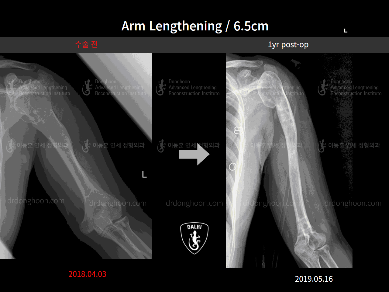 Before and after arm lengthening, case 4249373, image 3, Dr. Donghoon institute (DALRI)