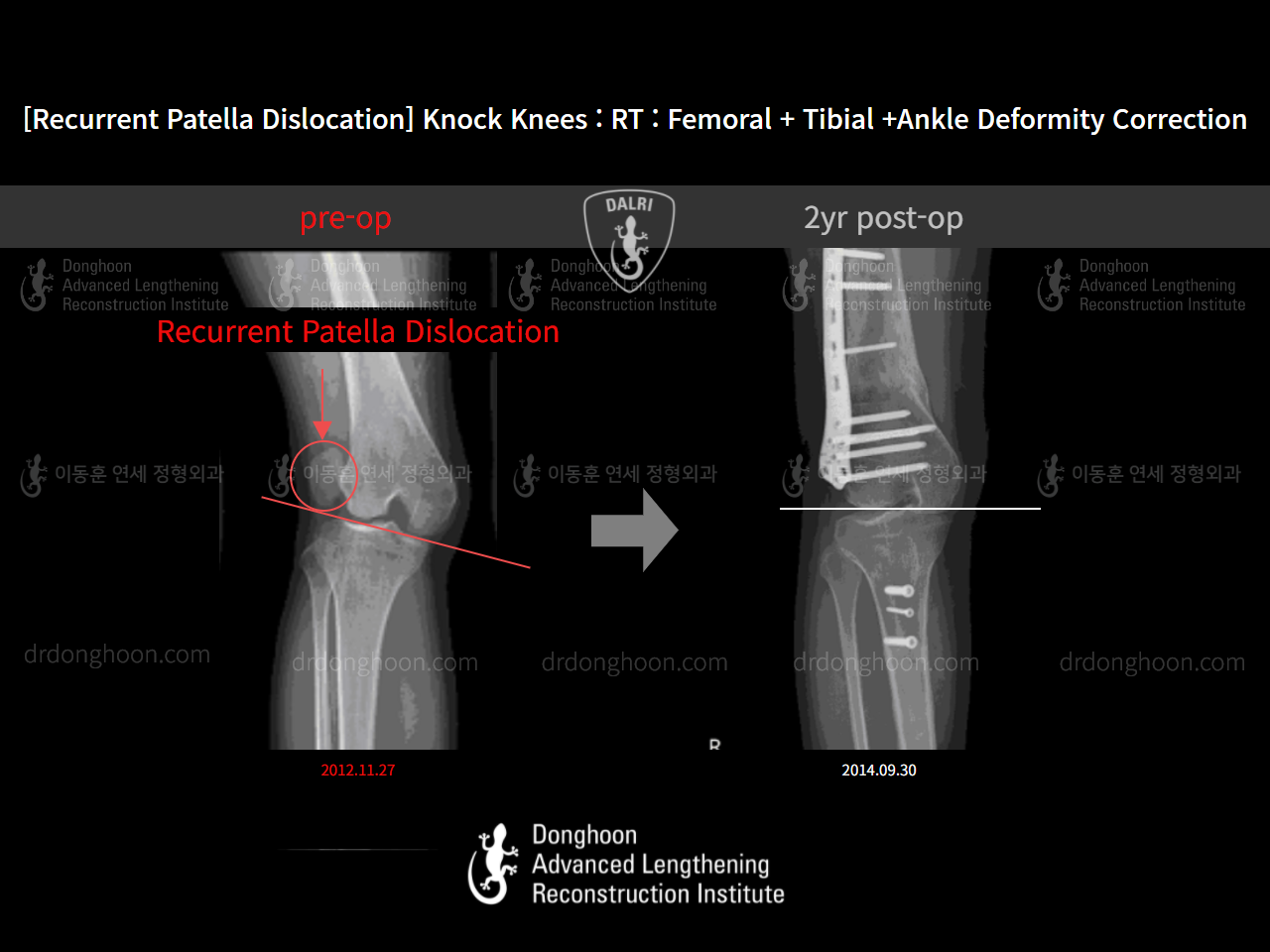 Before and after adult knock knees, case 10780541, image 4, Dr. Donghoon institute (DALRI)