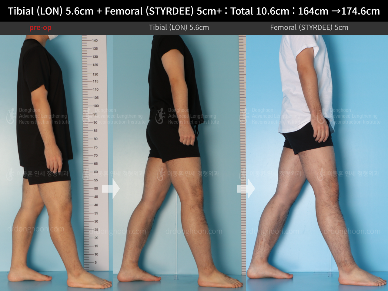 Before and after cll precice, case 13942494, image 3, Dr. Donghoon institute (DALRI)