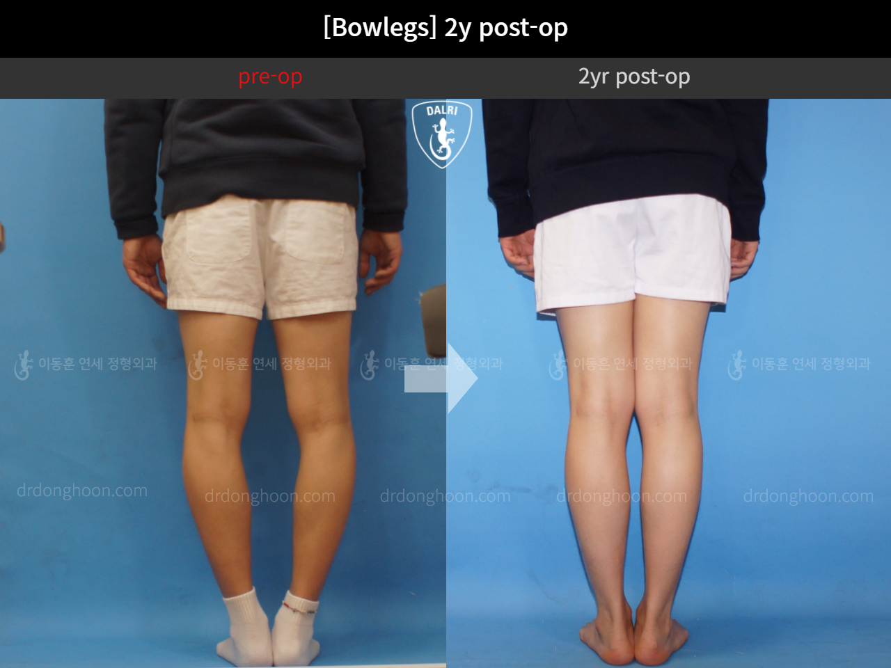 Before and after adult bowlegs, case 4311131, image 4, Dr. Donghoon institute (DALRI)