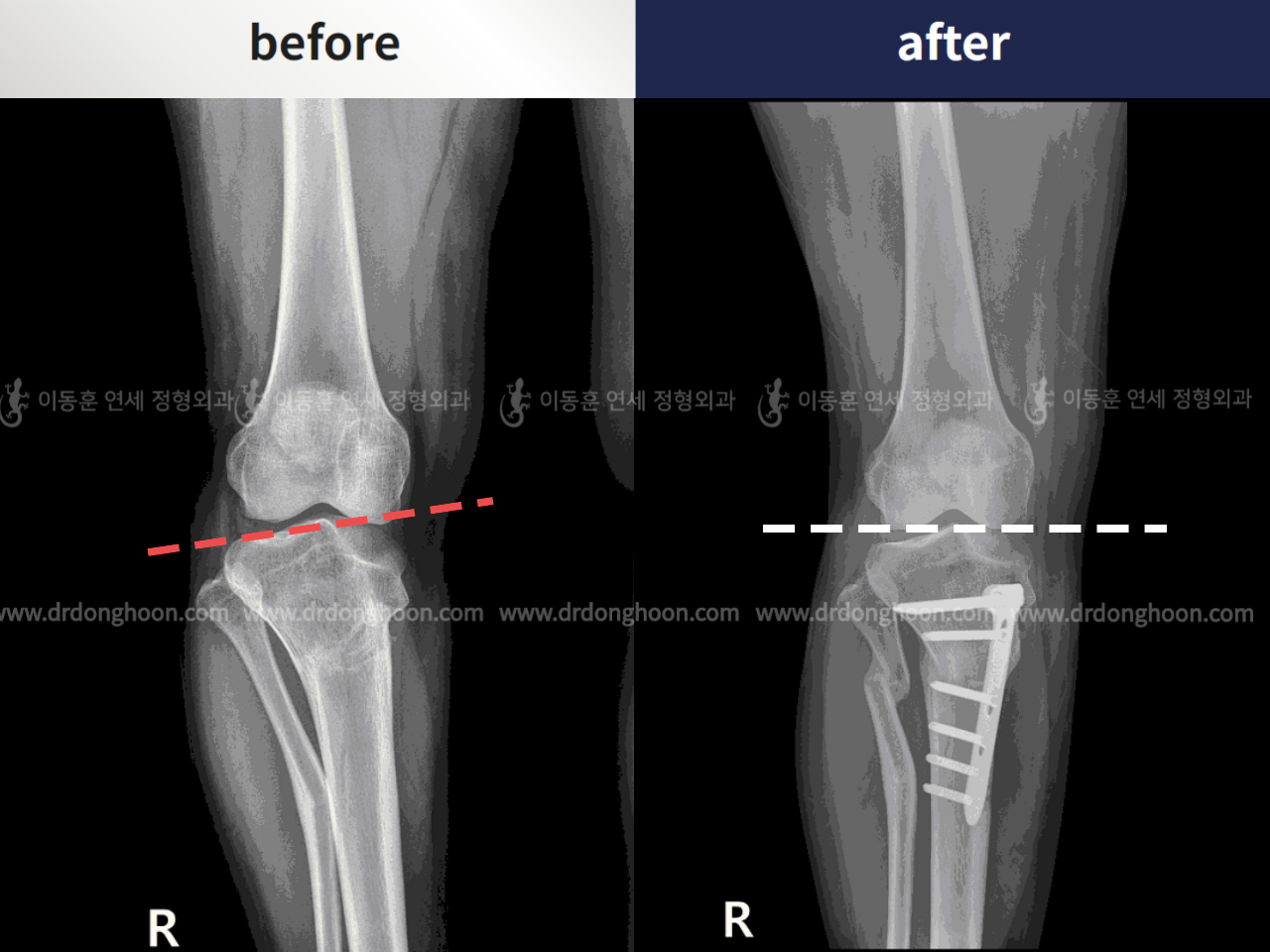 Before and after complex deformity, case 4297342, image 4, Dr. Donghoon institute (DALRI)