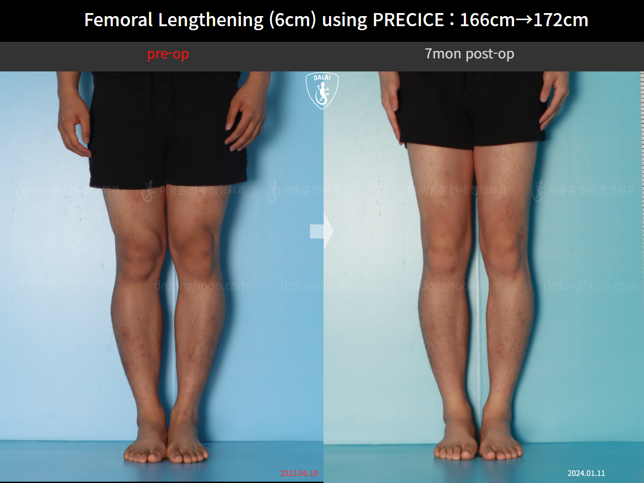 Before and after cll precice, case 17579263, image 5, Dr. Donghoon institute (DALRI)