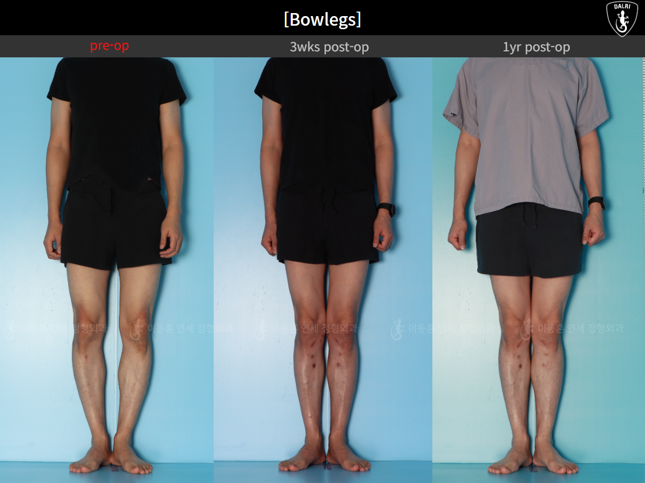 Before and after adult bowlegs, case 32564251, image 3, Dr. Donghoon institute (DALRI)