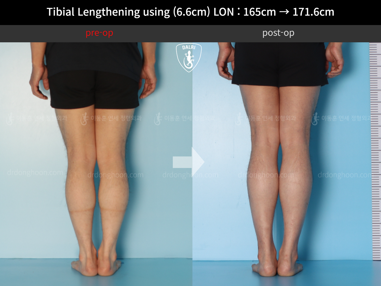 Before and after cll lon, case 12679338, image 6, Dr. Donghoon institute (DALRI)