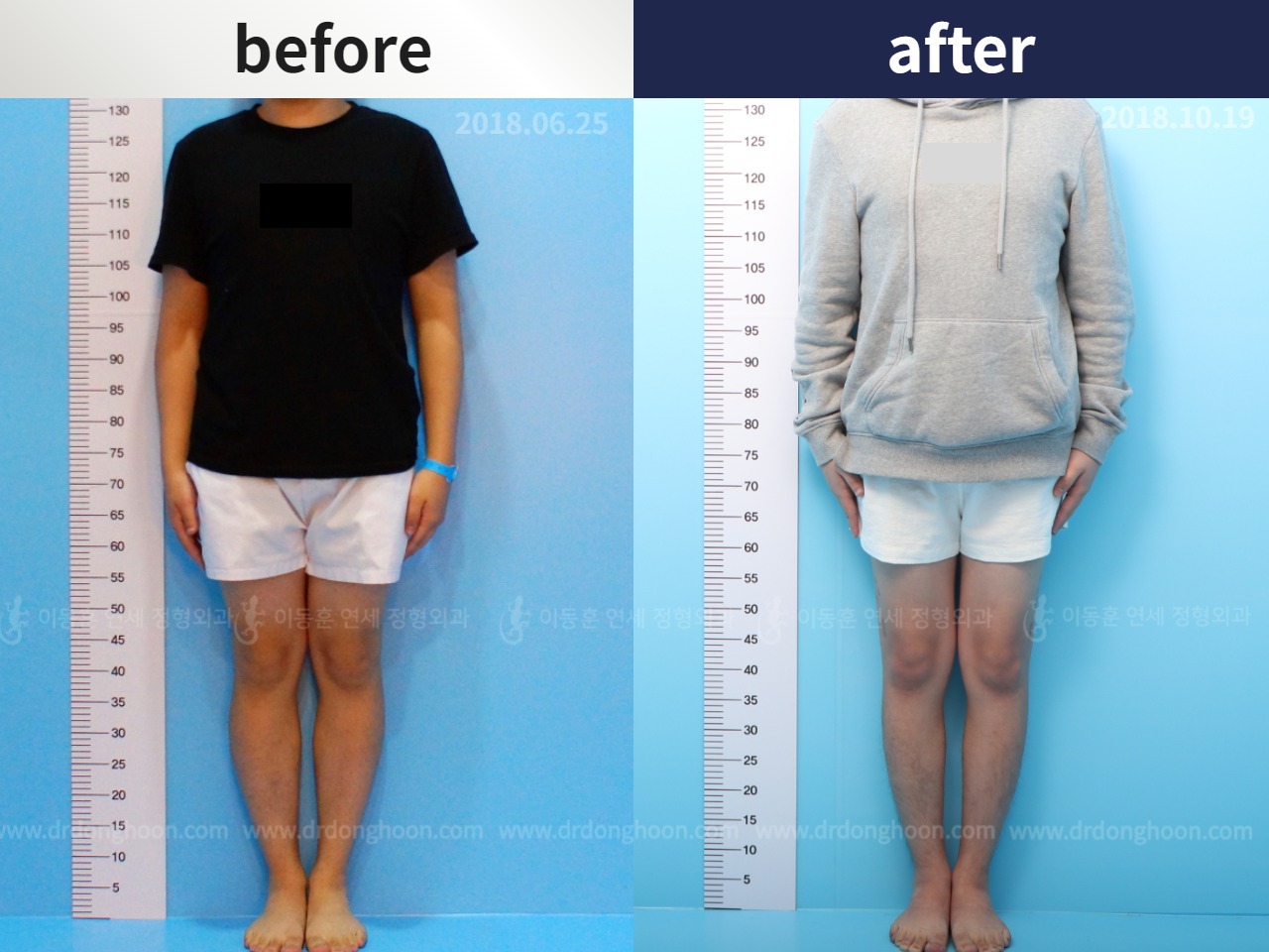 Before and after cll precice, case 4323419, image 1, Dr. Donghoon institute (DALRI)