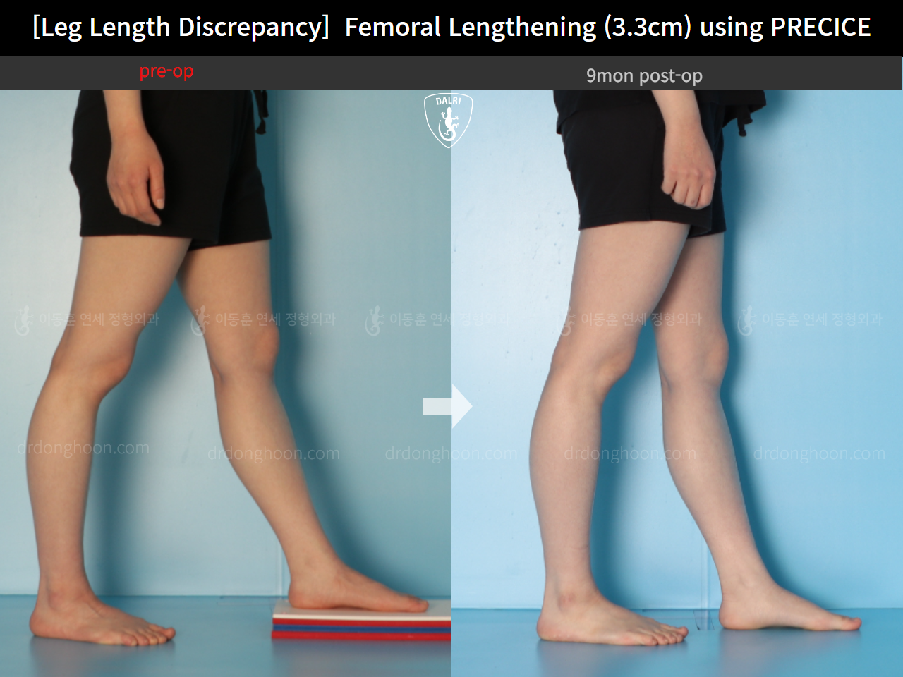 Before and after adult lld, case 14602297, image 7, Dr. Donghoon institute (DALRI)