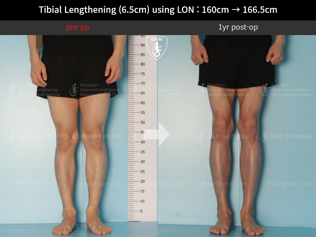 Before and after cll lon, case 10293105, image 5, Dr. Donghoon institute (DALRI)