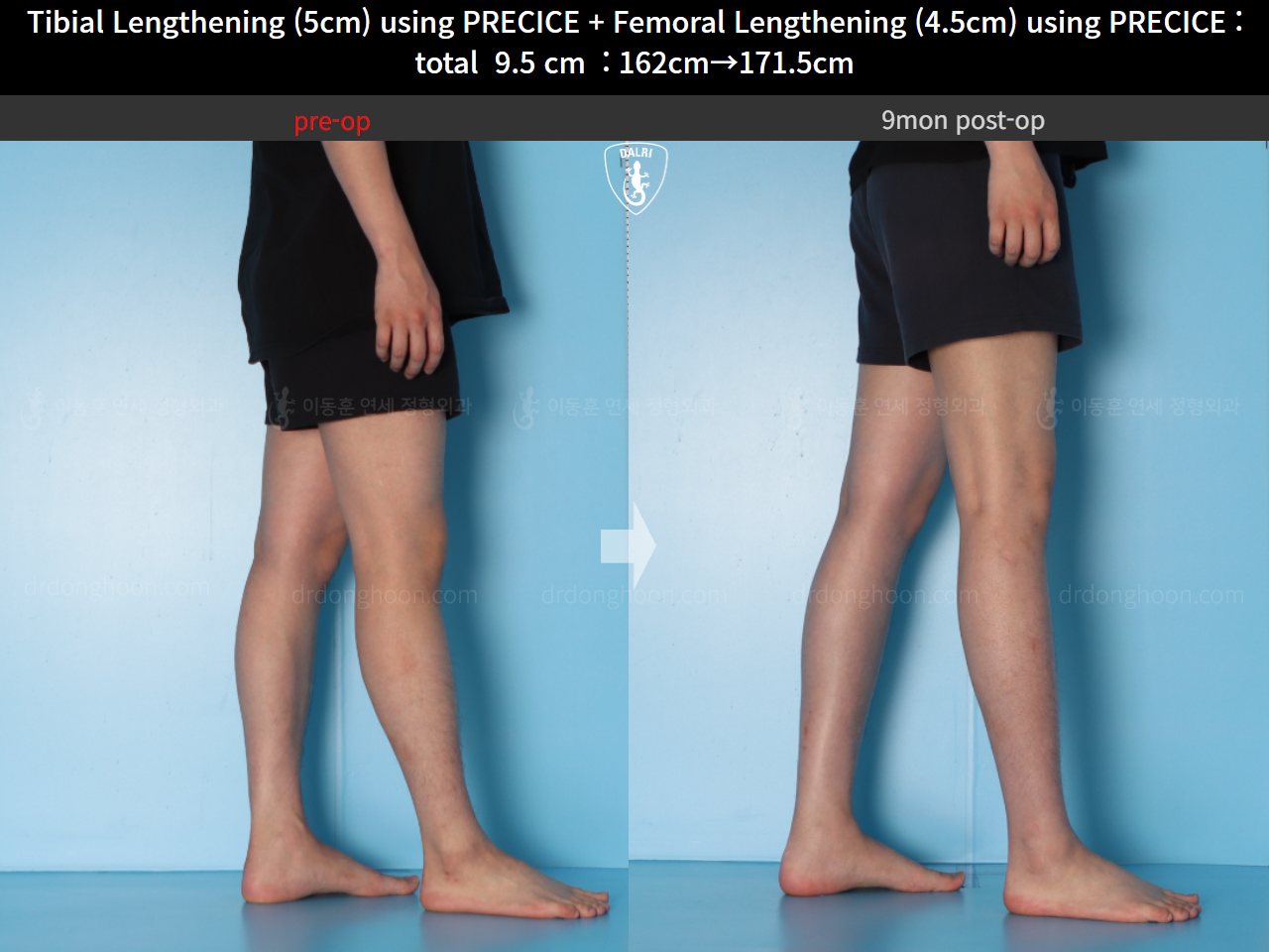 Before and after cll precice, case 15344460, image 11, Dr. Donghoon institute (DALRI)