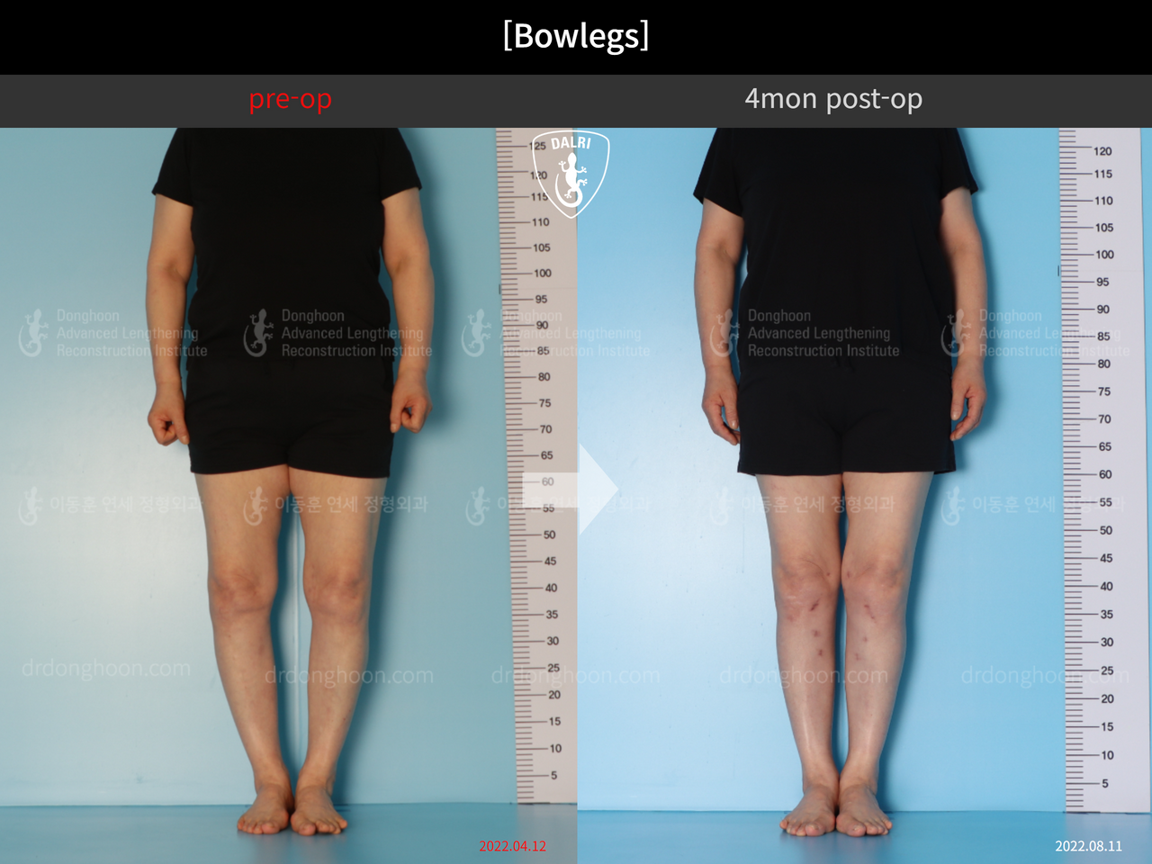 Before and after adult bowlegs, case 12586483, image 1, Dr. Donghoon institute (DALRI)