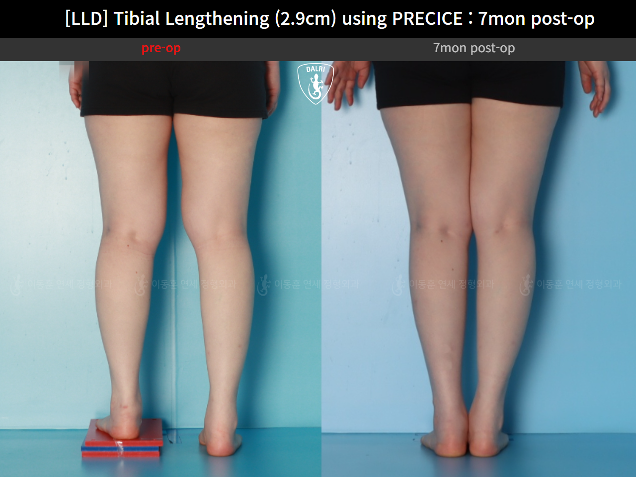 Before and after adult lld, case 62389039, image 6, Dr. Donghoon institute (DALRI)
